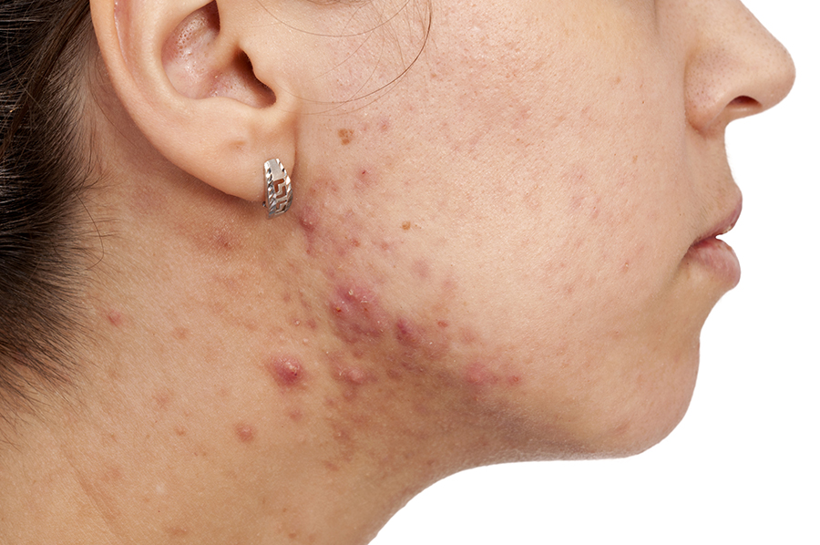 4 Types of Acne Pimples and How to Treat Them